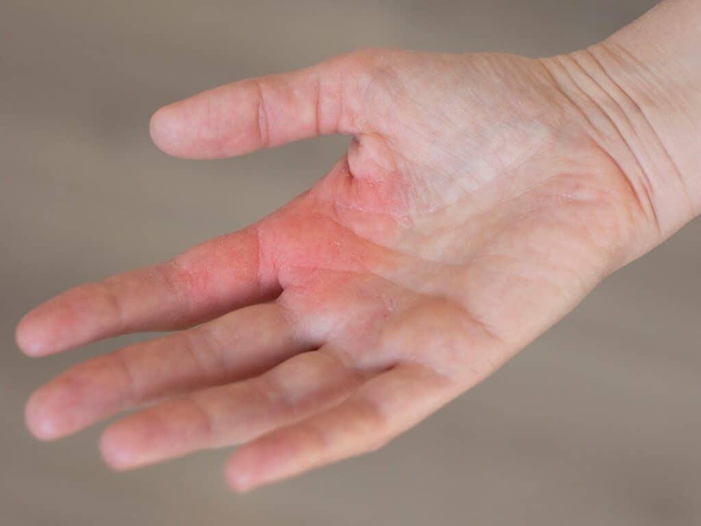 How to Treat Hand-Foot Syndrome From Chemotherapy 8 Untitled Project 5